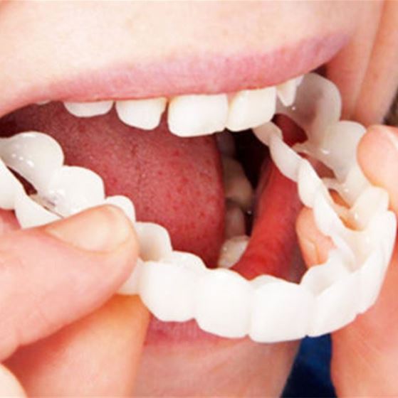 Snap-On Veneers | Flexible No-Glue Fit for Meals and Daily Wear 5