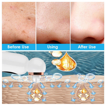 Mee-eter Remover and Hydrodermabrasion - HydraGlow