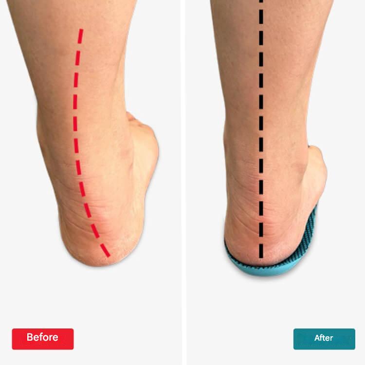 Orthopaedic Insoles – StepRelief