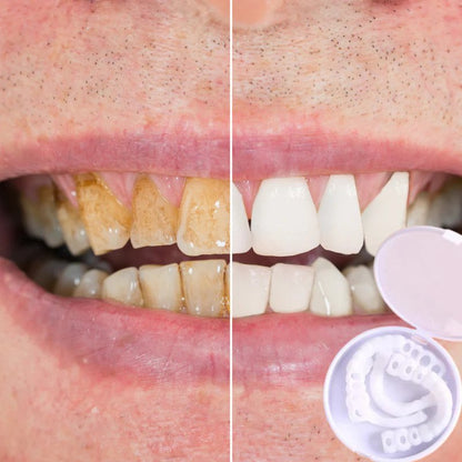 Snap-On Veneers | Flexible No-Glue Fit for Meals and Daily Wear 2