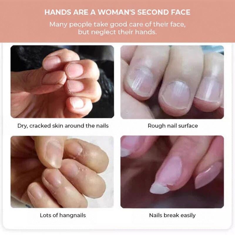 Four close-ups of dry, cracked, rough and brittle nails and cuticles, with captions in German 3