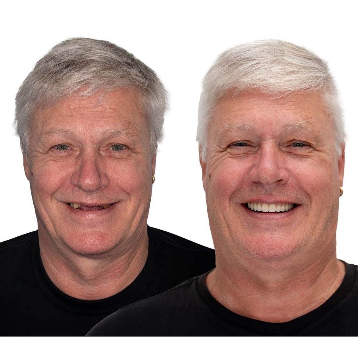 Before and after portraits of a grey-haired man, with a gappy smile on the left and a full bright smile on the right. 5