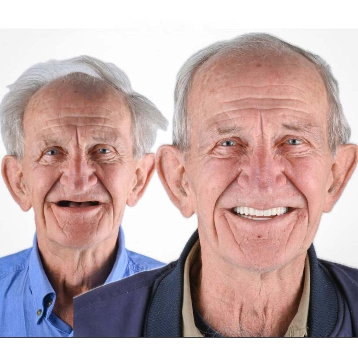 Before and after portraits of an elderly man, toothless on the left and smiling with a complete set of white teeth on the right. 6